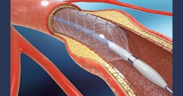Govt cuts prices of coronary stents