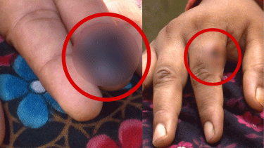 Mysterious livestock-linked disease sparks panic in Rangpur