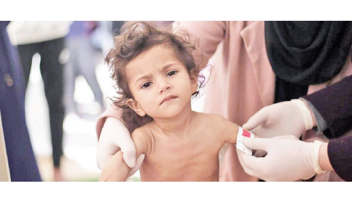 Nearly one in six children in Gaza acutely malnourished: Study