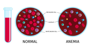 Young Bangladeshi Women Face Alarming Rates of Anemia: Study