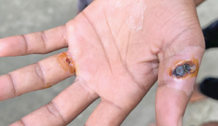 BAU team finds 11 cases of human infections in Gaibandha
